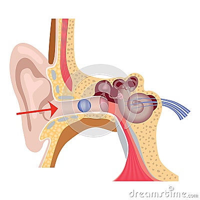 Foreign body in the inner ear. Vector Illustration